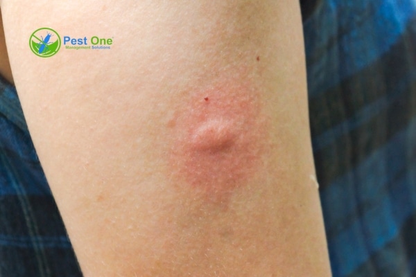 Bị mối cắn có sao không? Giải đáp lo lắng cho bạn