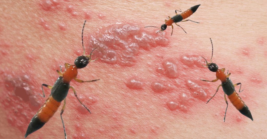 Cách Diệt Kiến Ba Khoang Tận Gốc An Toàn Tại Nhà 7 VIÊM DA TIẾP XÚC DỊ ỨNG DO KIẾN BA KHOANG - Hotline: 1800969666