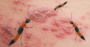 VIÊM DA TIẾP XÚC DỊ ỨNG DO KIẾN BA KHOANG - Hotline: 1800969666