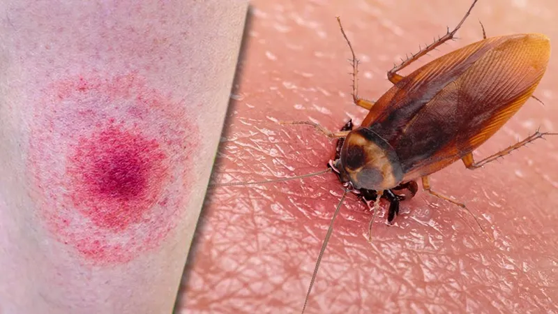 Gián Có Cắn Không Tác Hại Và Cách Xử Lý An Toàn Khi Bị Cắn 7 Bị gián cắn có ảnh hưởng gì?