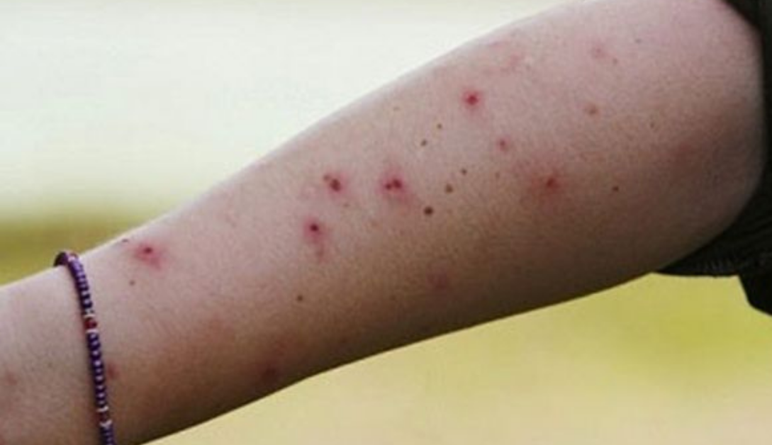 7 Loài Kiến Có Hại Phổ Biến Ở Việt Nam Và Cách Xử Lý 9 Vết kiến cắn sưng thâm và cách ngăn chặn kiến hiệu quả