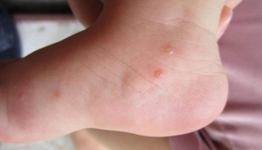 Vòng Đời Của Loài Kiến 4 Giai Đoạn Và Cách Kiểm Soát 13 Bị kiến cắn nổi mụn nước và cách xử lý an toàn - Nhà thuốc FPT Long Châu